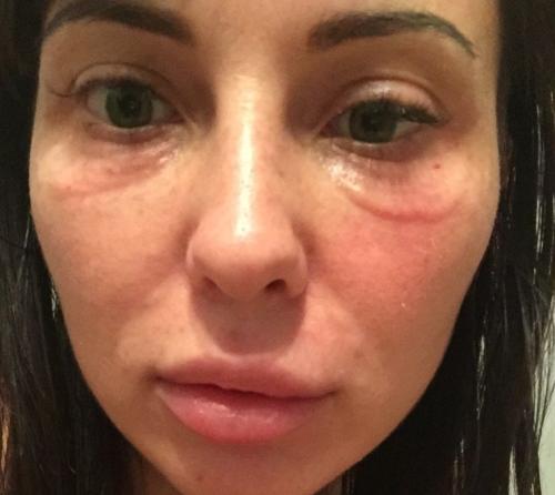 Биоревитализация глаз отеки. Причины отечности вокруг глаз