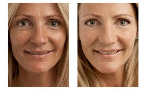 Биоревитализация кожи лица гиалуроновой кислотой. Что такое биоревитализация лица и ее эффективность