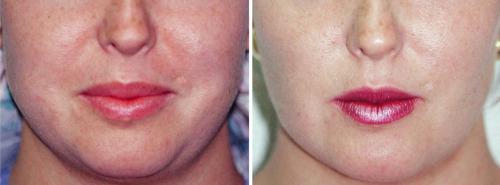 Биоревитализация гиалуроновой кислотой VS старение кожи. Показания и противопоказания 01