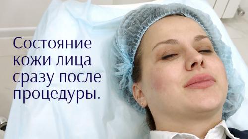 Отличие мезотерапии от биоревитализации лица. Отличия процедур 13