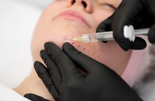 Биоревитализация и мезотерапия в чем разница. Чем отличается мезотерапия от биоревитализации