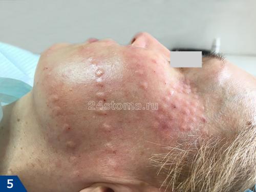 Что нельзя делать перед биоревитализацией. Техника проведения биоревитализации  –