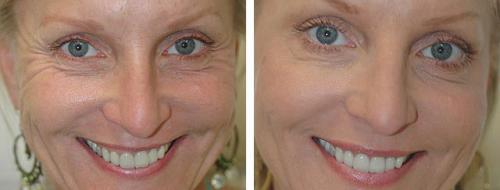 Ответы на часто задаваемые вопросы о биоревитализации. Гиалуроновая кислота: что о ней известно? 05